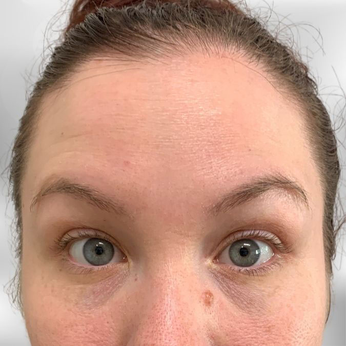 Forehead Wrinkles After Treatment with Dysport