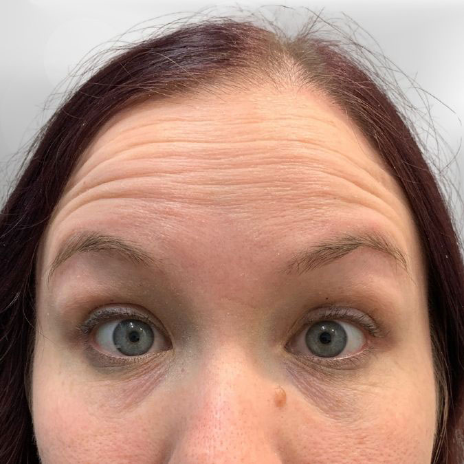 Forehead Wrinkles Before Treatment with Dysport