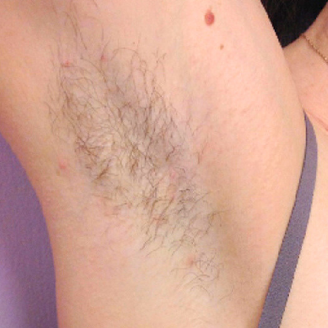 Laser Hair Removal