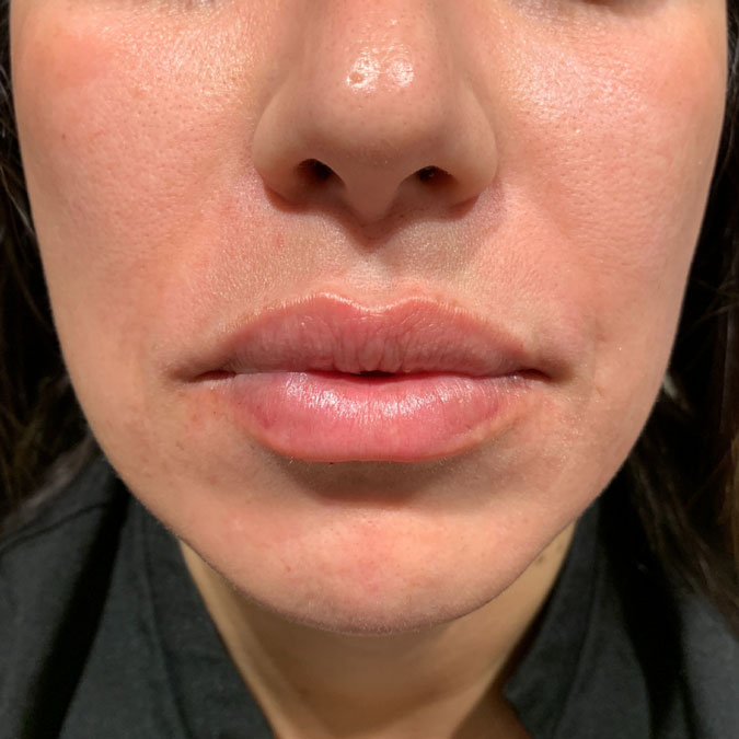 Lips after treatment with dermal filler at Empire Aesthetic Center