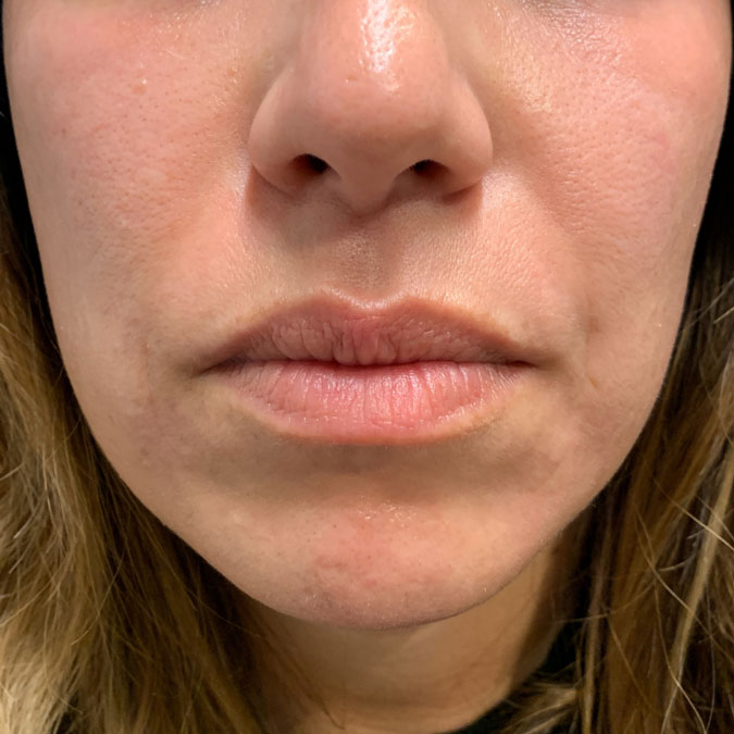 Lips before treatment with dermal filler at Empire Aesthetic Center