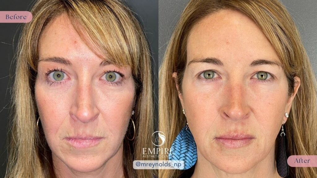 Sculptra and Dermal Filler Before & After at Empire Aesthetic Center in Bakersfield