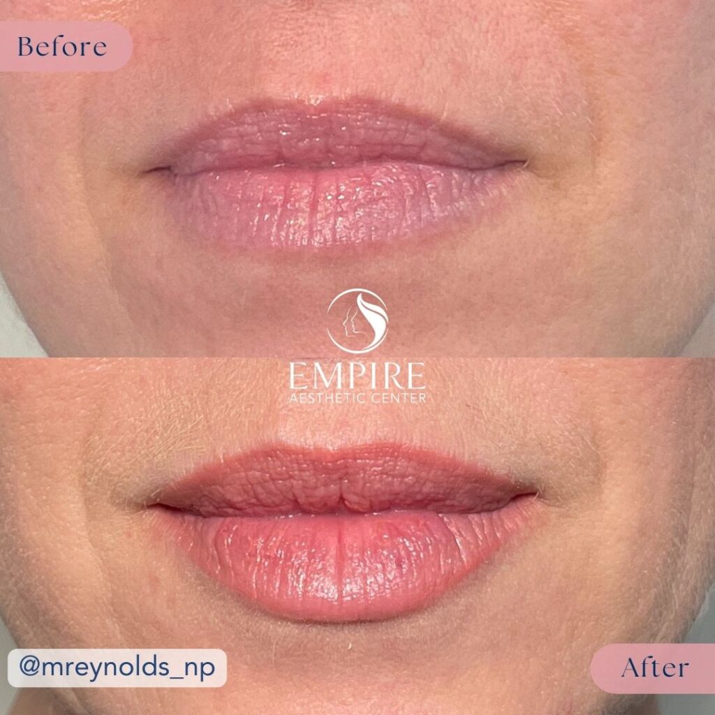 Filler Before and After in Bakersfield