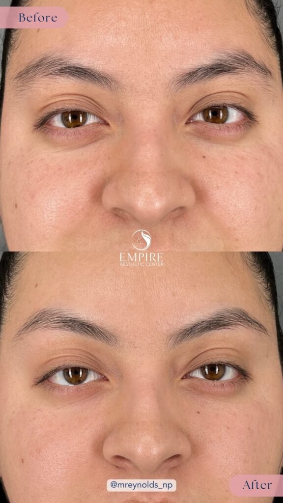 19 units of Dysport Before and After in Bakersfield