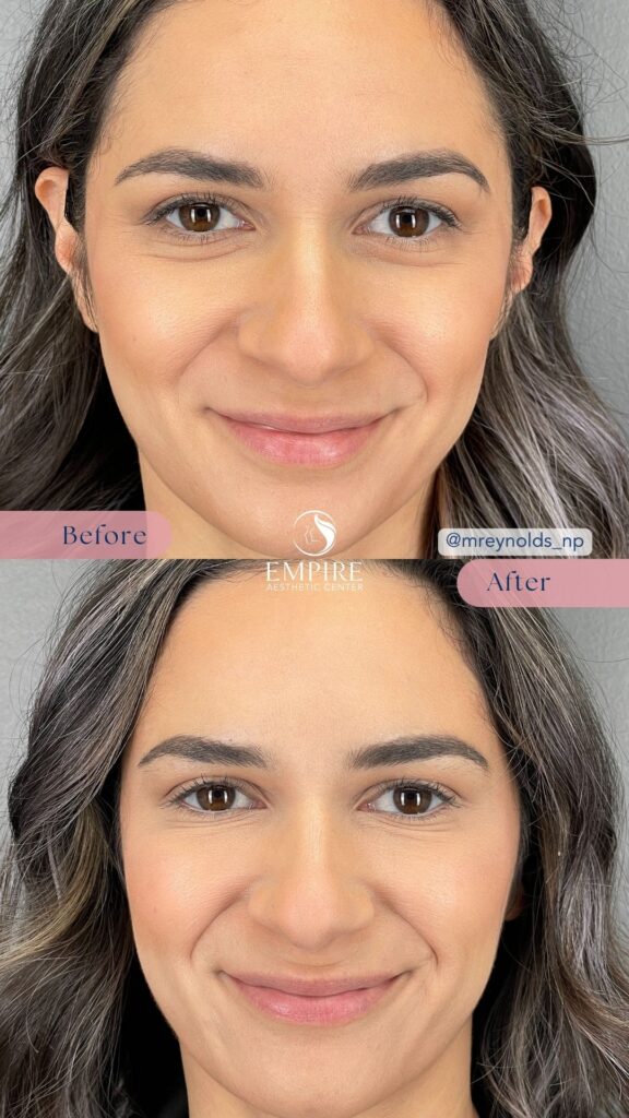 45 units of Dysport Before and After in Bakersfield