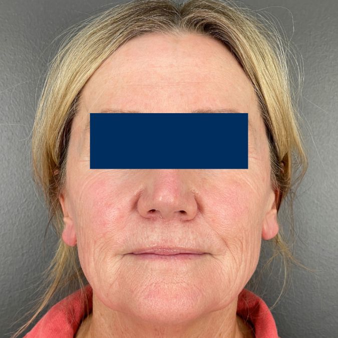 A woman with new, glowing skin after a chemical peel