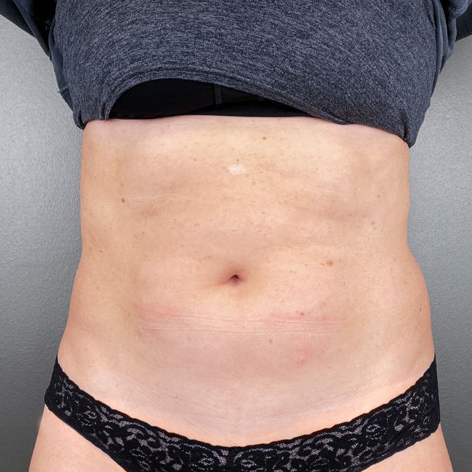 The more toned abdomen of a woman after Emsculpt