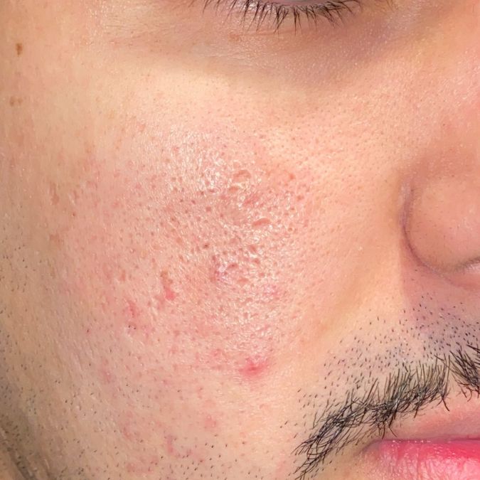 A close up of improved acne scars after Microneedling