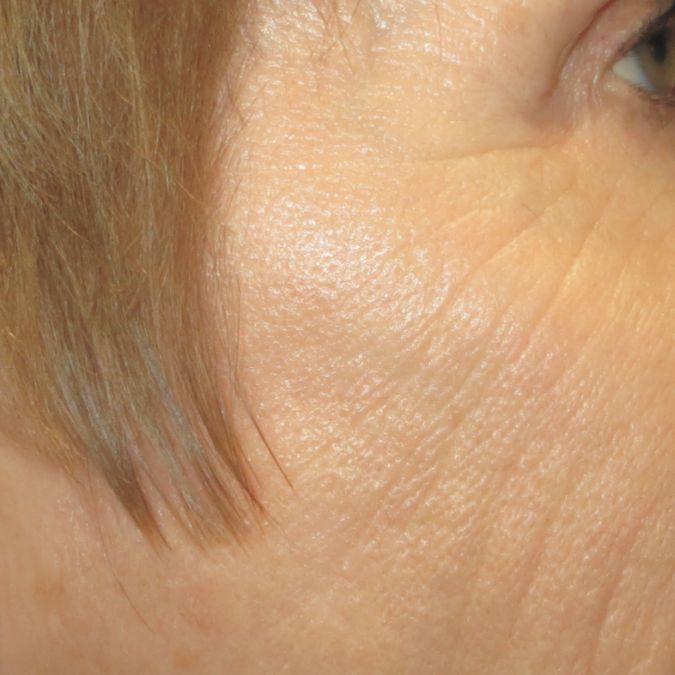 A close up of a woman's face showing fewer wrinkles and smoother skin after a profractional treatment.