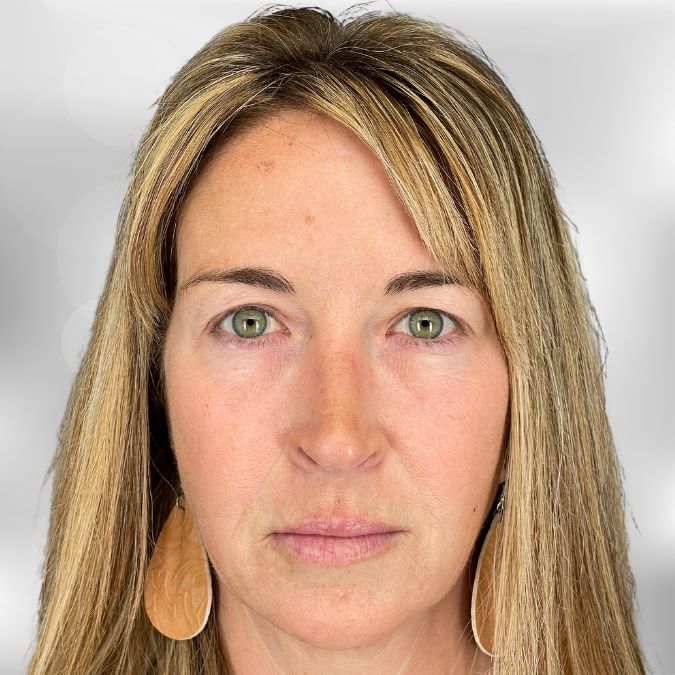 After treatment with Sculptra.