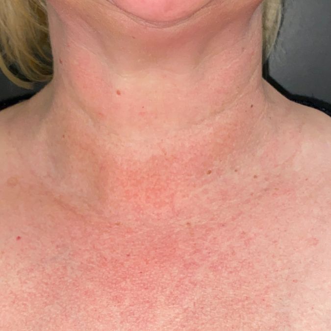 A woman's neck with reduced hyperpigmentation.