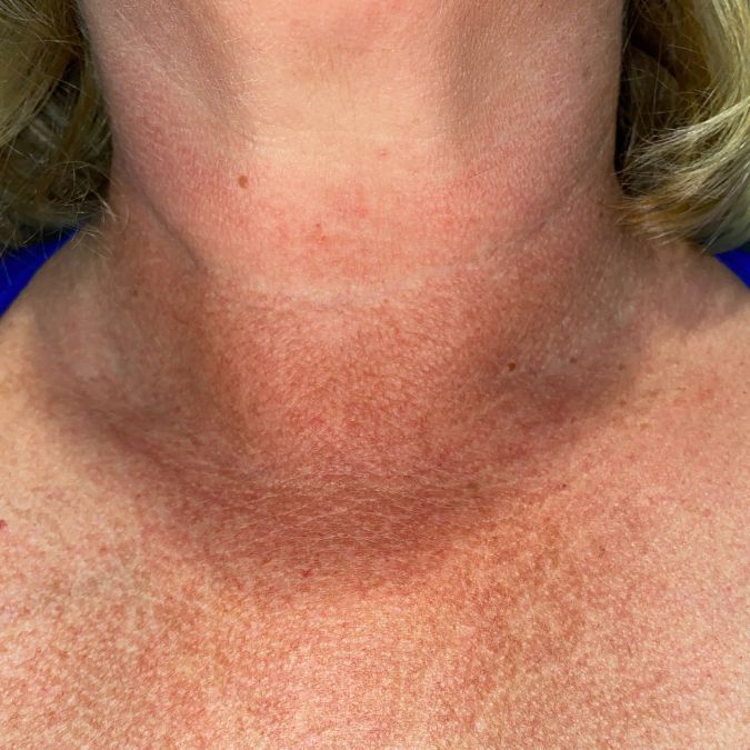 A woman's neck with many brown spots.