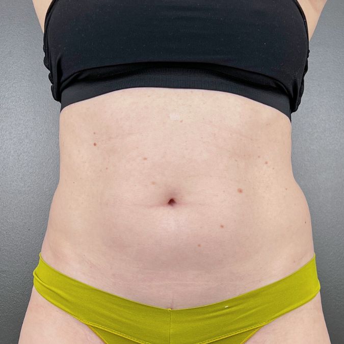 The abdomen of a woman before Emsculpt