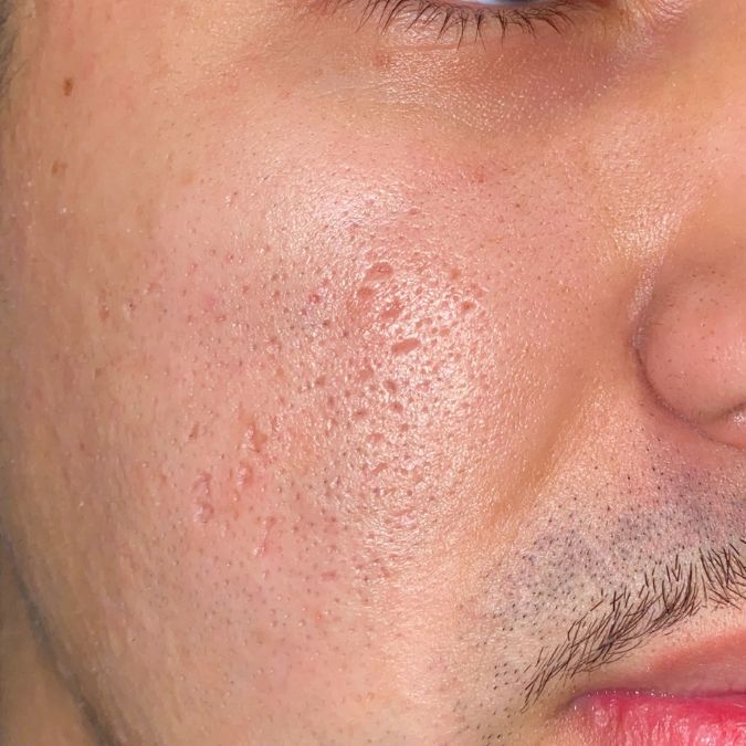 A close up of acne scars