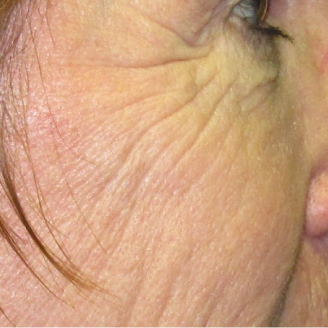 Before Profractional in Bakersfield