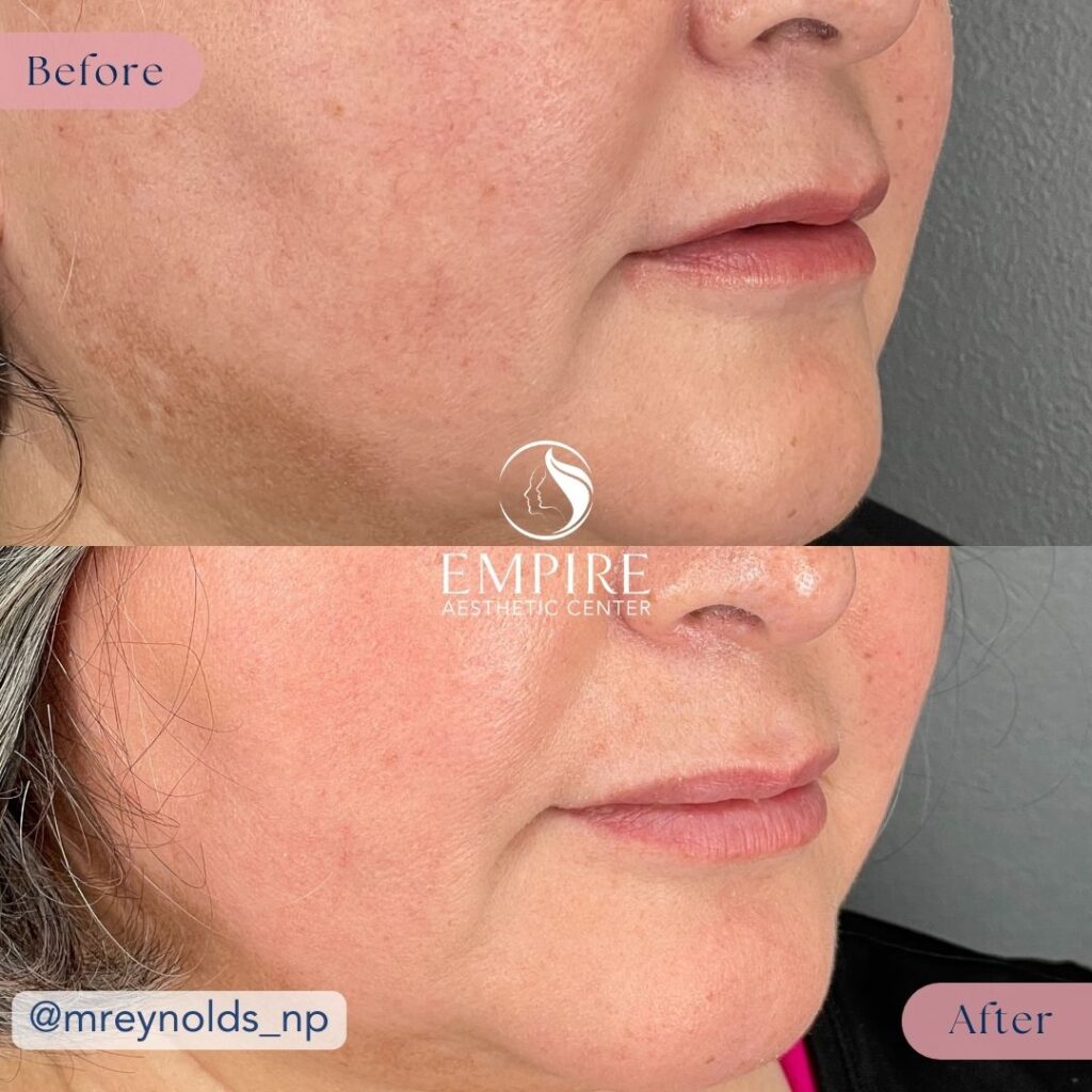Lip Filler Before and After in Bakersfield