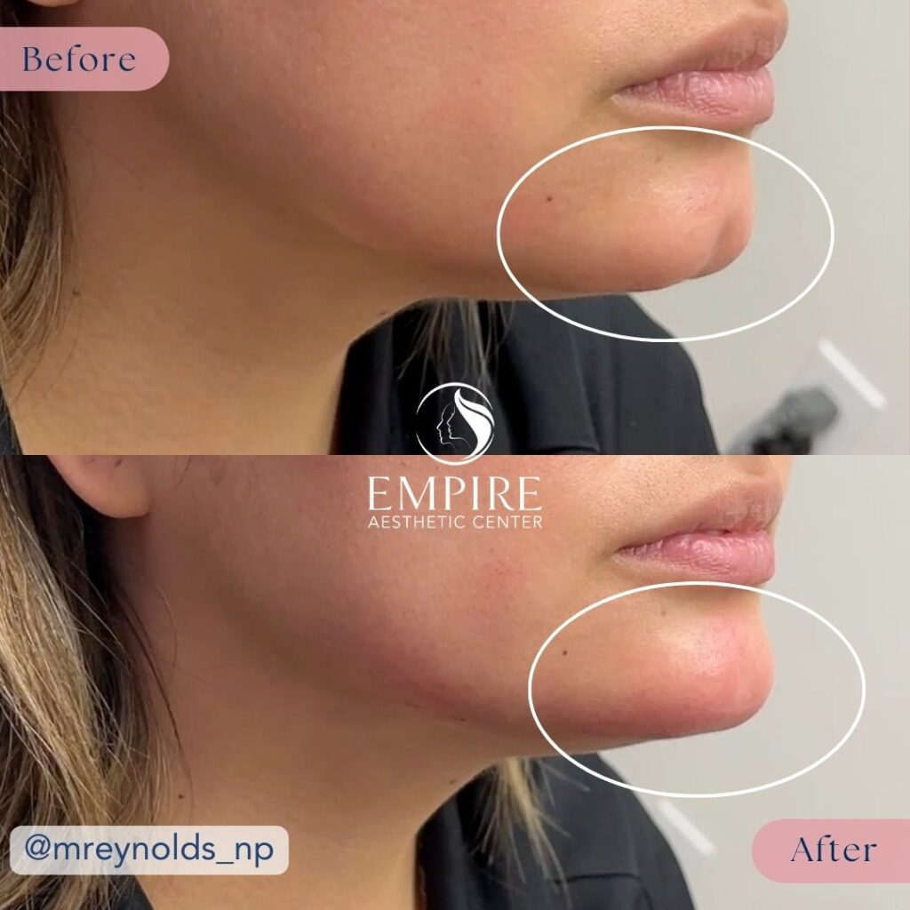 Chin Filler Before and After in Bakersfield