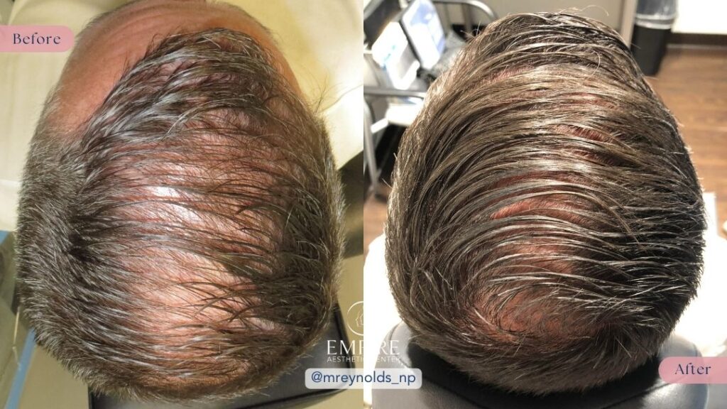 Hair Regrowth Before and After in Bakersfield