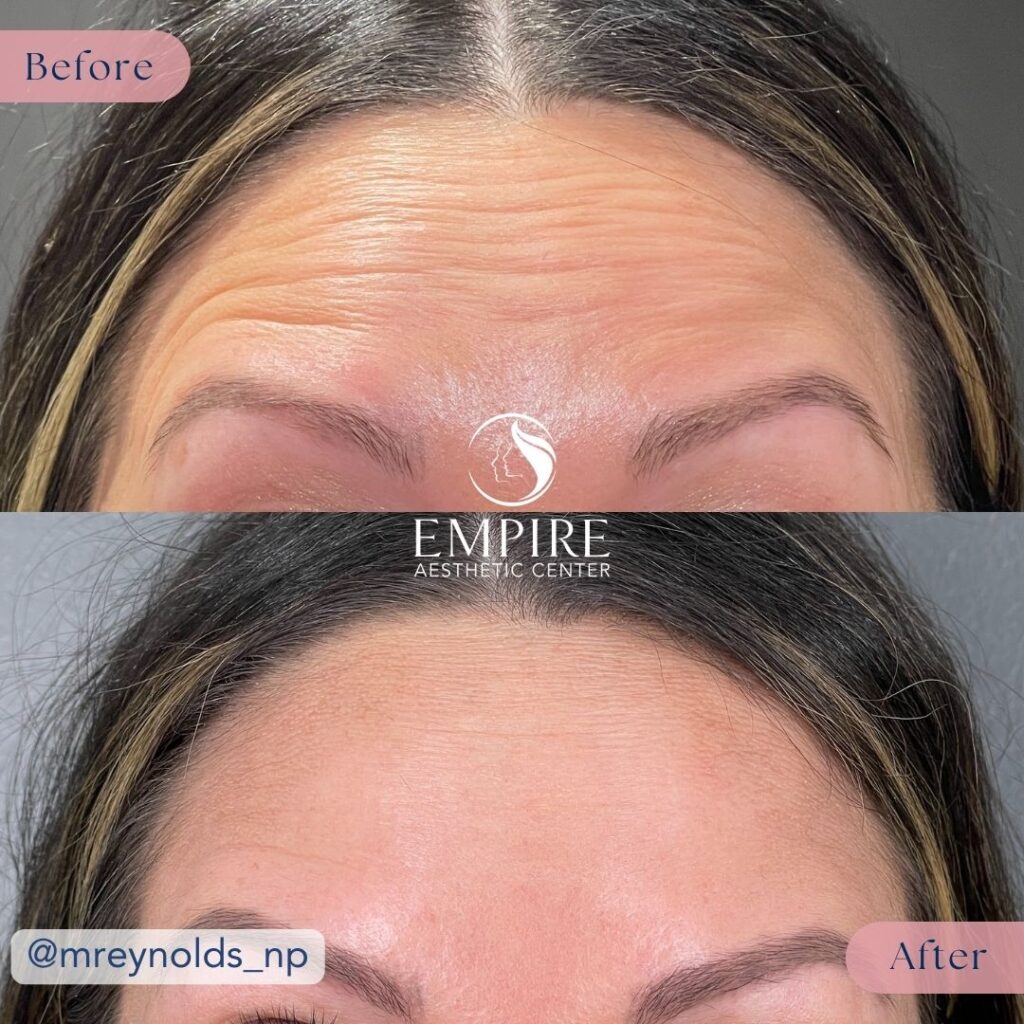 Daxxify Before and After in Bakersfield