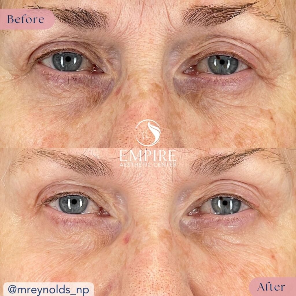 EZ Gel Before and After in Bakersfield
