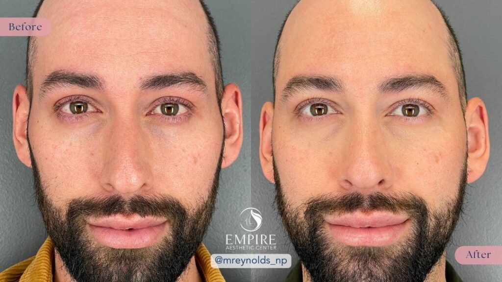EZ Gel tear trough treatment and temple filler before and after in Bakersfield.