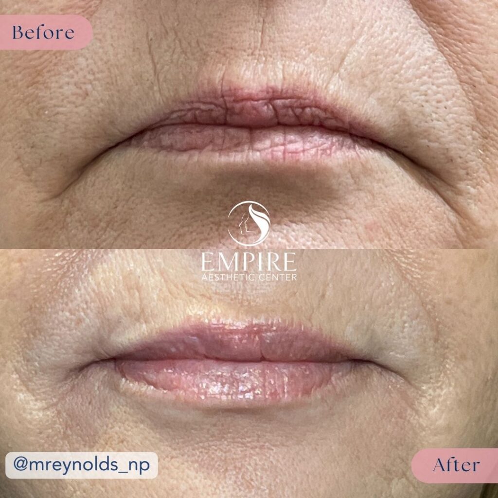 Lip Filler Before and After in Bakersfield