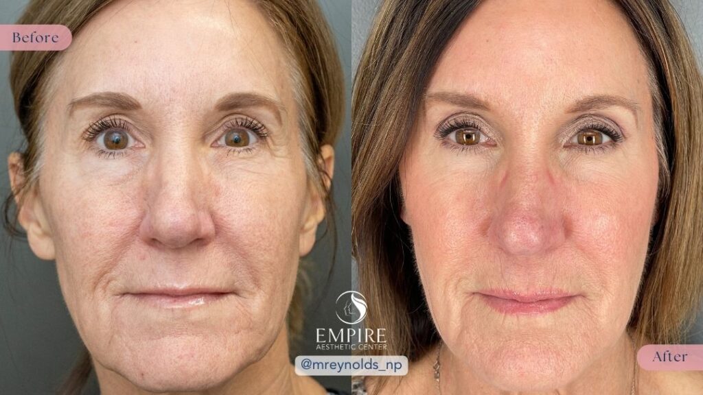 Sculptra Before and After in Bakersfield