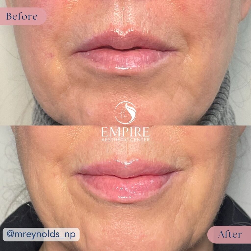 Lip Filler Before and After in Bakersfield