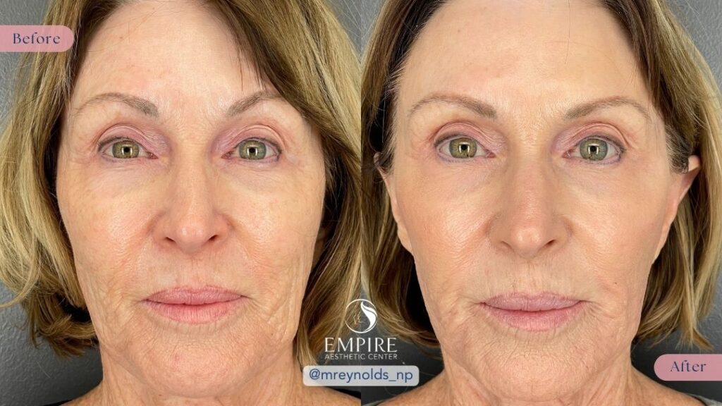 PDO Thread Lift, Dysport, and Dermal Fillers Before and After in Bakersfield