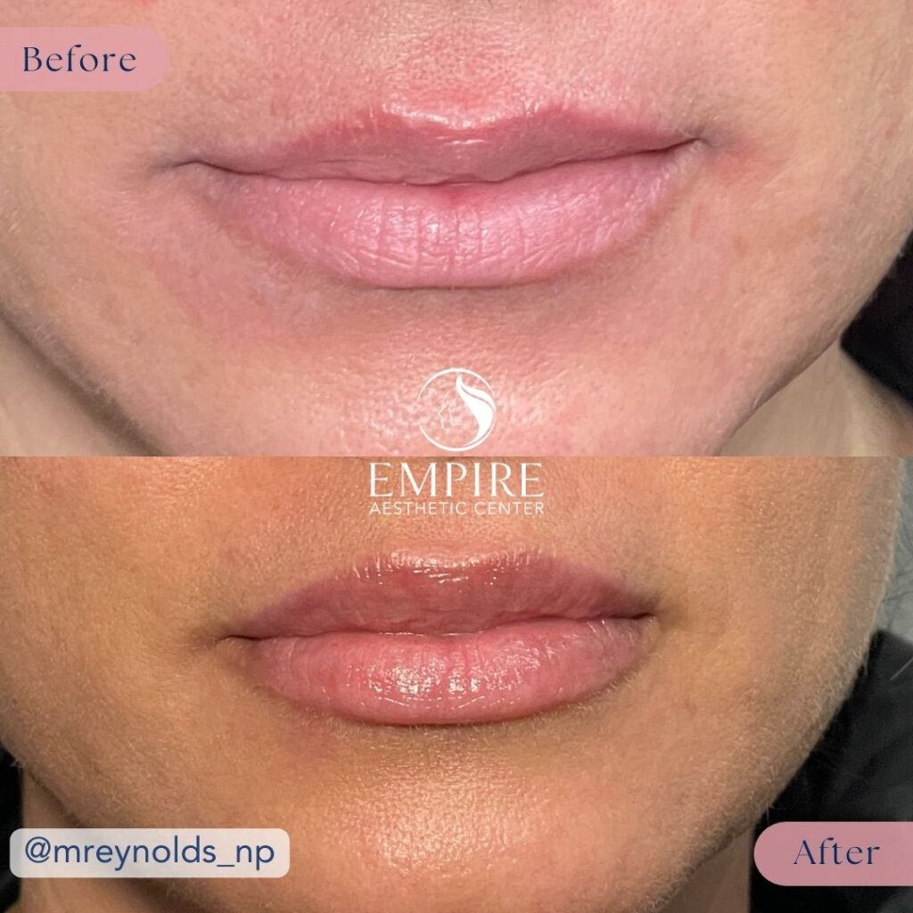 Filler Before and After in Bakersfield