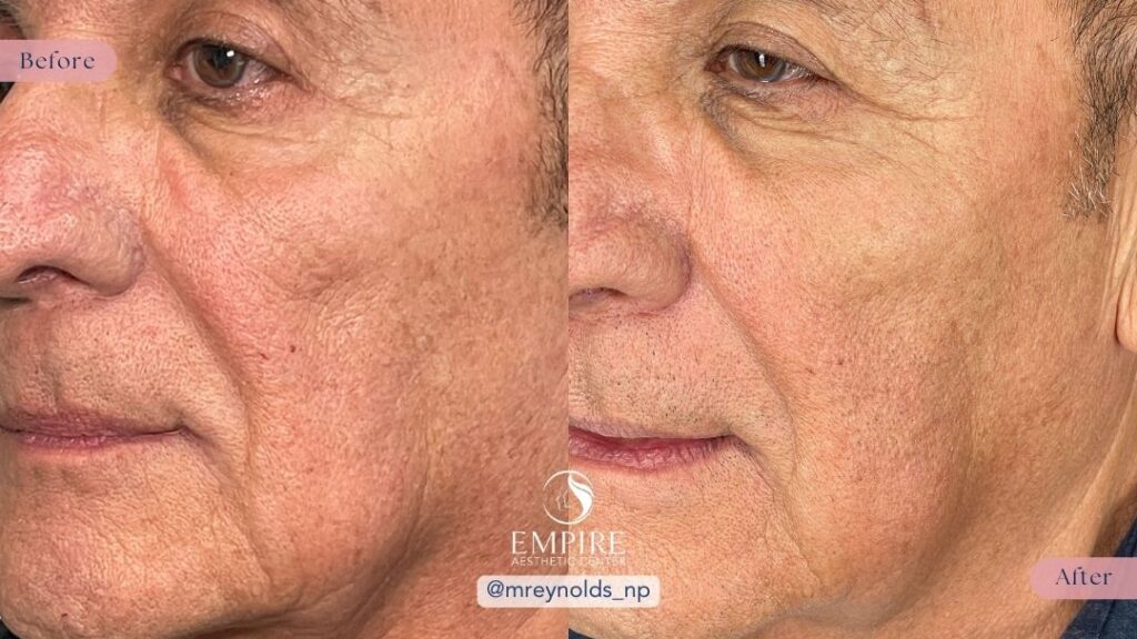 Sculptra Before and After in Bakersfield