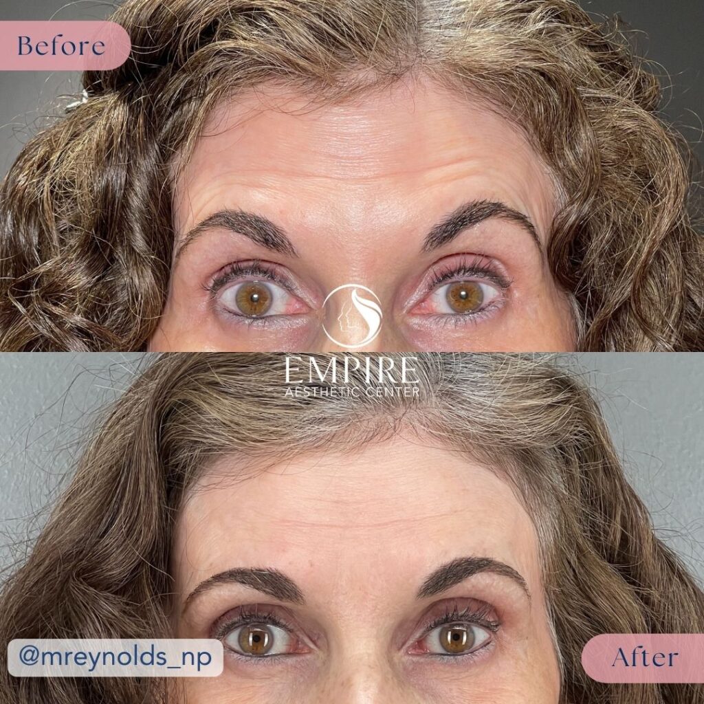 145 units of Daxxify Before and After in Bakersfield