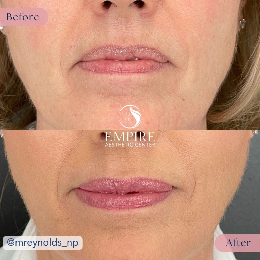 Lip Filler Before and After in Bakersfield