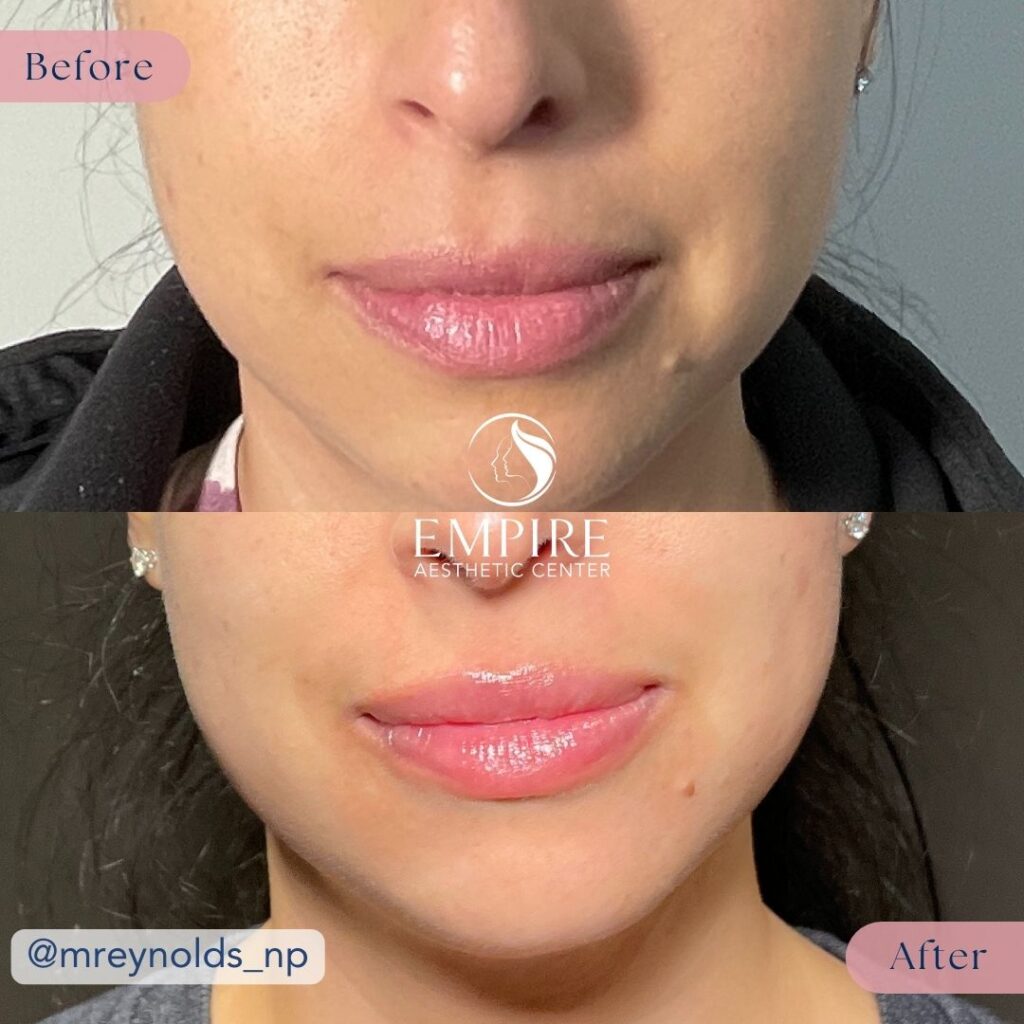 Filler Before and After in Bakersfield