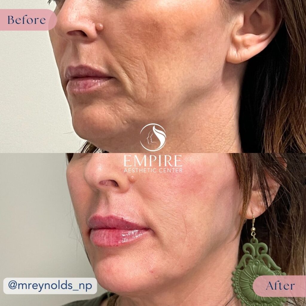 Sculptra and Lip Filler Before and After in Bakersfield