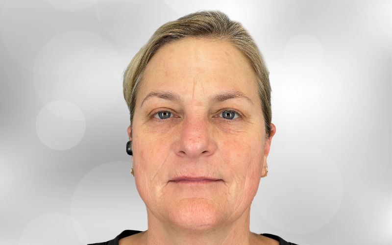 A woman with reduced hyperpigmentation after treatment with BBL Photofacial
