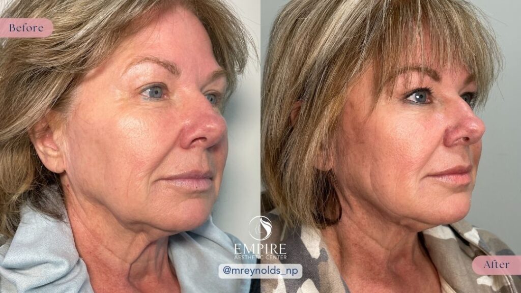 PDO Thread Lift Lower Face Before and After in Bakersfield