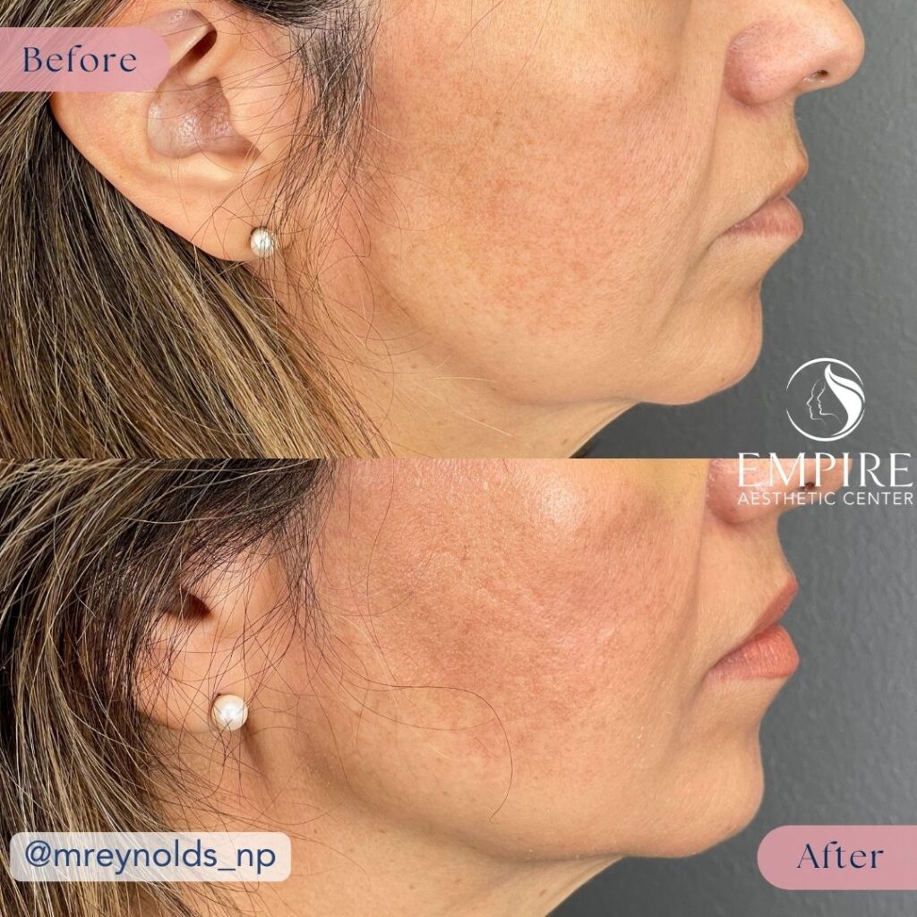 PDO Thread Lift Lower Face Before and After in Bakersfield