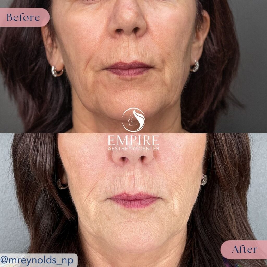 Thread Lift Before and After in Bakersfield