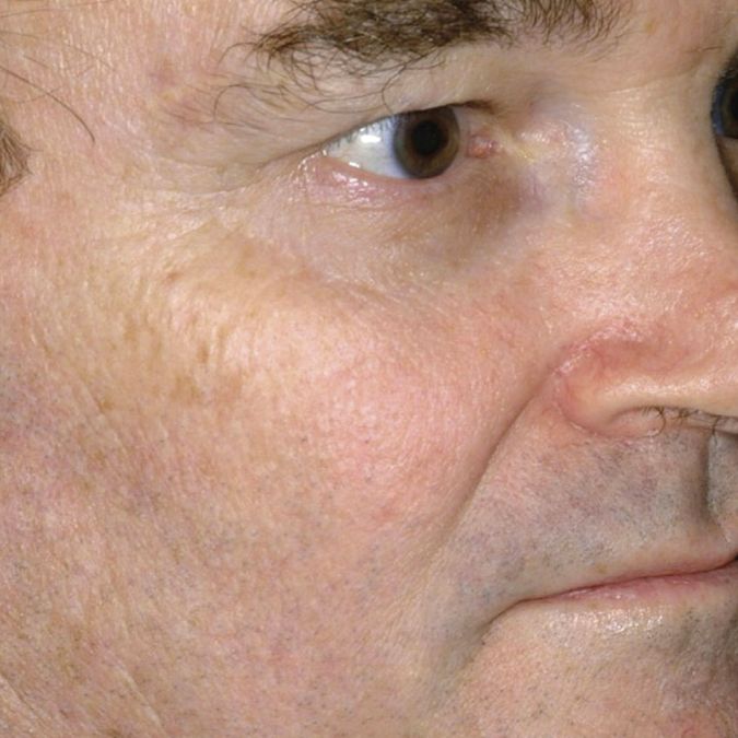A close up of a man's face showing reduction of skin redness and sun damage after a microlaserpeel