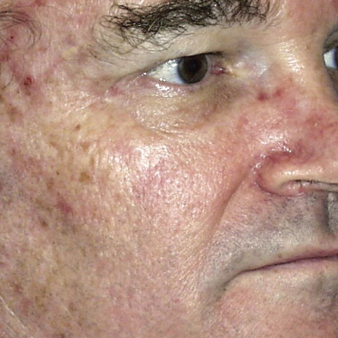 A close up of a man's face showing skin redness and sun damage