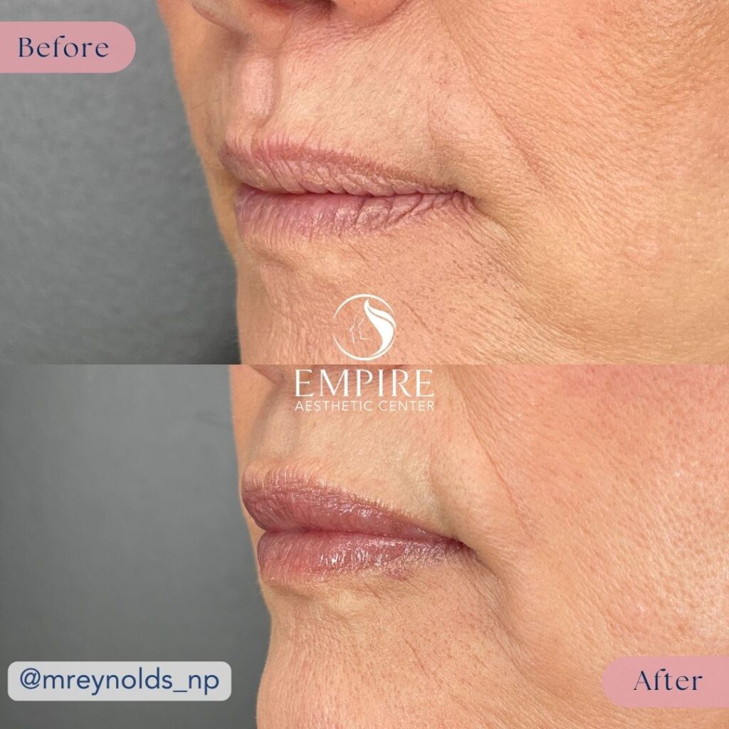 lip filler before and after