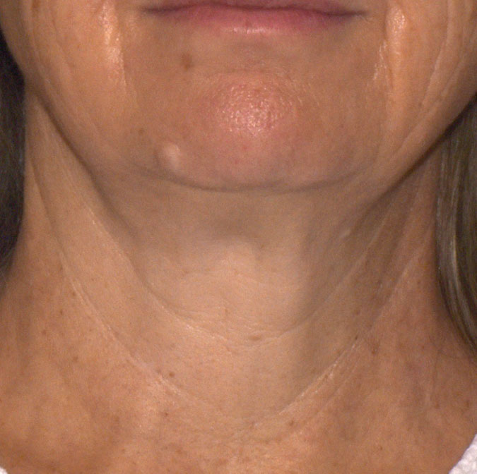A photo showing tighter neck skin after treatment with Sofwave
