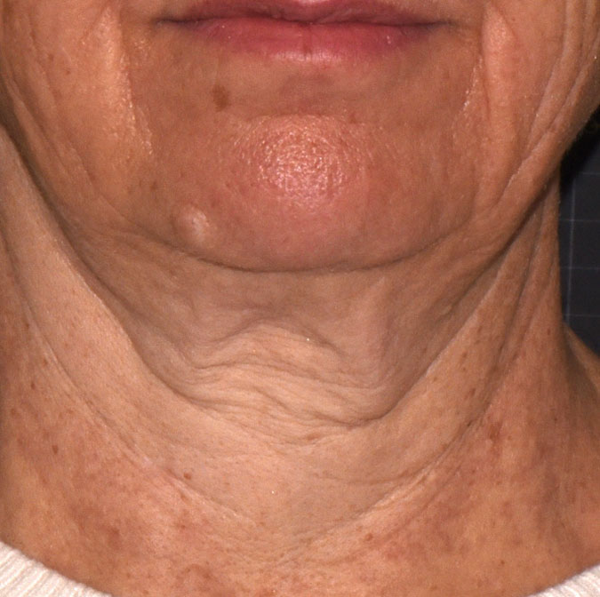 A photo showing sagging neck skin.