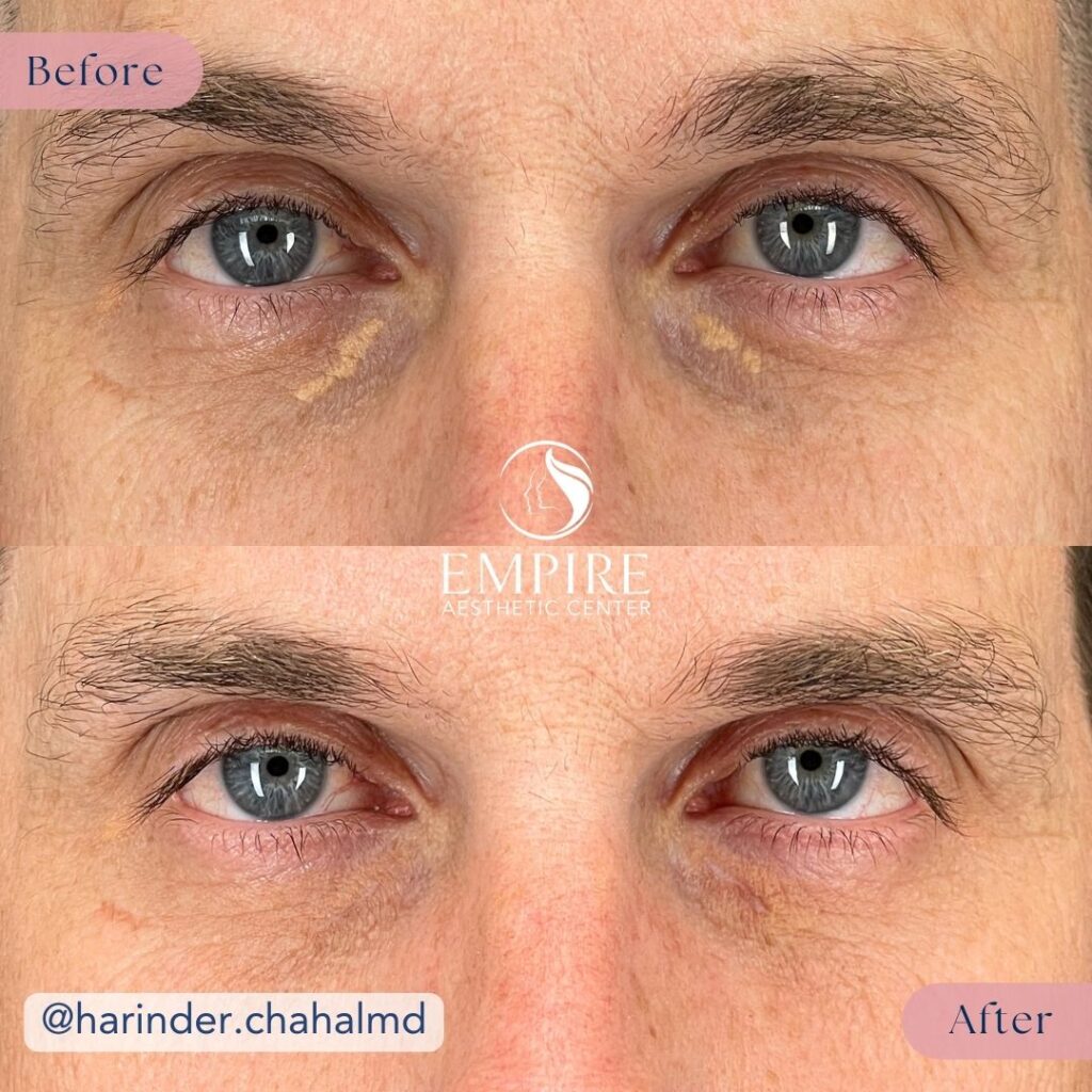 A before and after comparison showing the results of a Xanthelasma Removal in Bakersfield