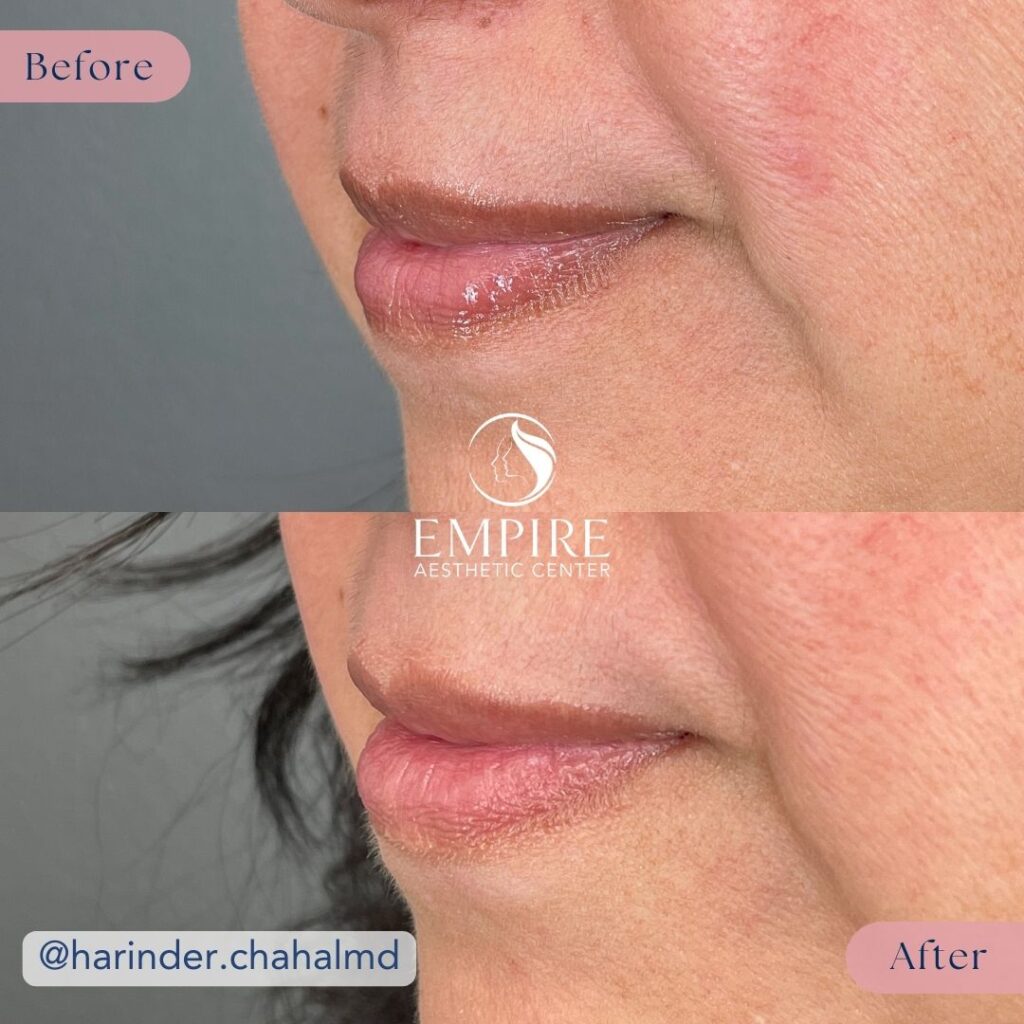 A before and after comparison showing the results of a Lip Filler treatment in Bakersfield