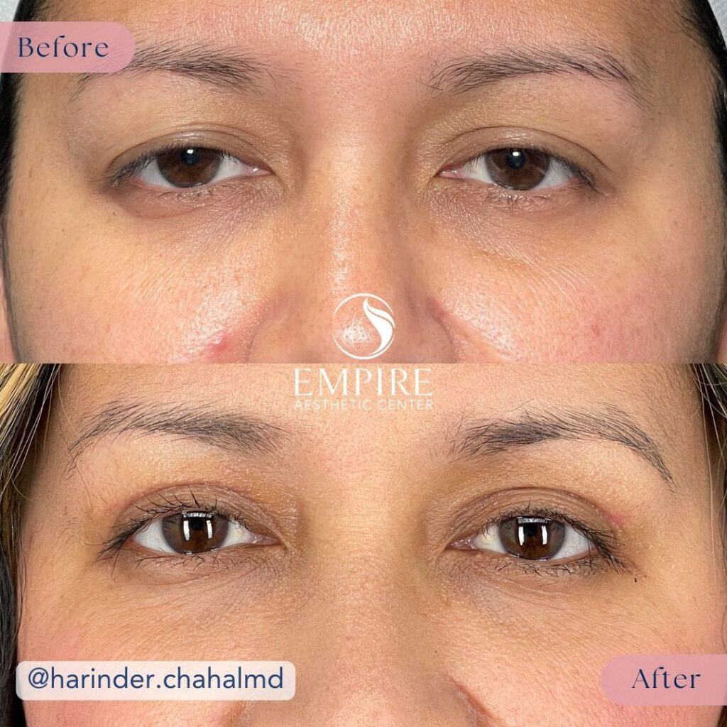A before and after comparison showing the results of an Upper Eyelid Blepharoplasty in Bakersfield