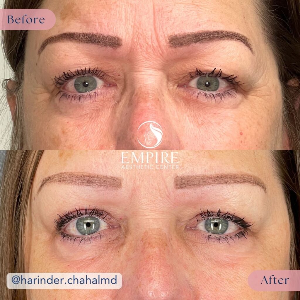 A before and after showing the results of a bilateral Upper Eyelid Blepharoplasty and Browpexy in Bakersfield.