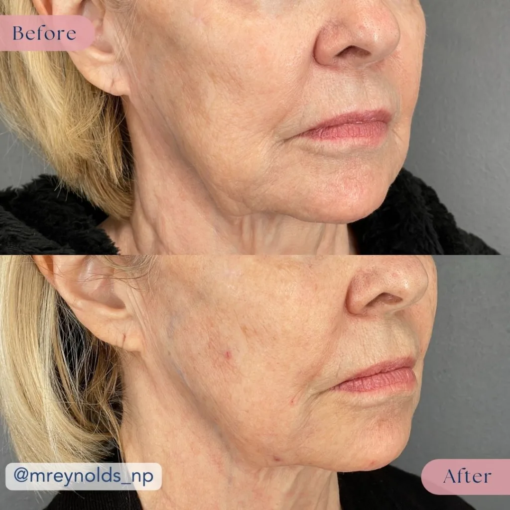 A before and after comparison showing the results of a Sofwave and filler treatment in Bakersfield