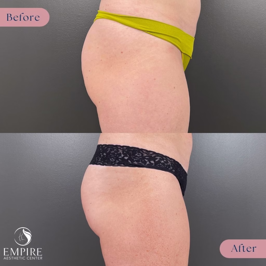 Emsculpt glutes treatment before and after images